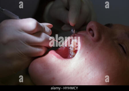 Patient au cabinet de dentistes, l'obtention de tissu mou testé et nettoyer les dents du tartre et de la plaque dentaire, la prévention des maladies parodontales. Douloureux, l'hygiène dentaire Banque D'Images