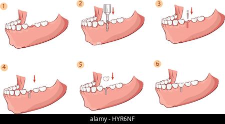 Vector illustration d'une illustration d'un implant dentaire Illustration de Vecteur