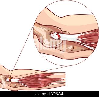 Tennis Elbow - déchirure au tendon extenseur commun du bras Illustration de Vecteur