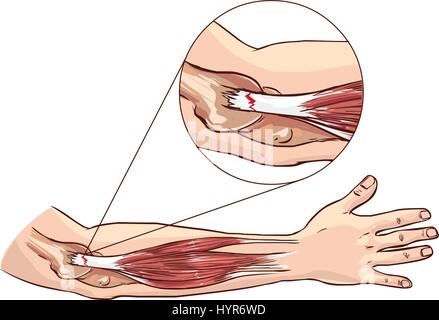 Tennis Elbow - déchirure au tendon extenseur commun du bras Illustration de Vecteur