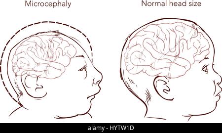 Illustration d'un nouveau-né avec microcéphalie maladie causée par le virus Zika Illustration de Vecteur