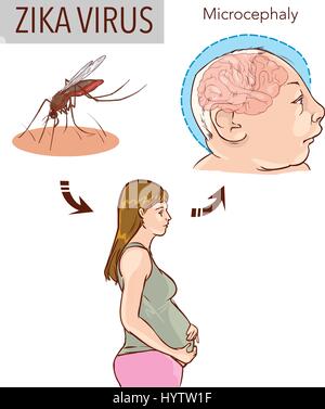 Illustration d'une enceinte de zika virus et nouveau-né avec la maladie de microcéphalie Illustration de Vecteur