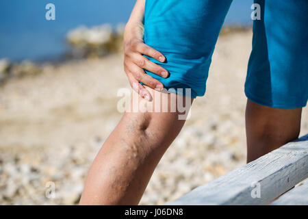 Woman touching varices douloureuses sur une jambe Banque D'Images