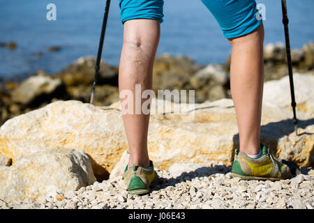 Femme avec des varices sur une jambe à l'aide de bâtons de marche à pied Banque D'Images