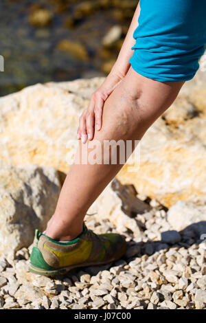 Woman touching varices douloureuses sur une jambe Banque D'Images