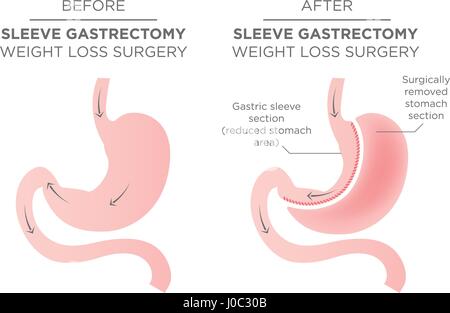 Agrafage de l'estomac chirurgie bariatrique résultant en 1/4 de retiré de l'estomac. Illustration de Vecteur