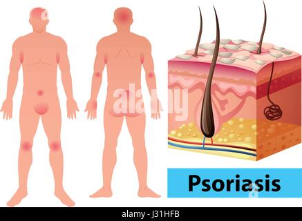 Schéma montrant le psoriasis dans les droits de l'illustration Illustration de Vecteur