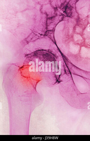 Fracture de la hanche, X-RAY Banque D'Images