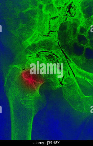Fracture de la hanche, X-RAY Banque D'Images