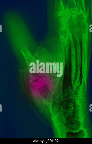 La main fracturée, X-RAY Banque D'Images