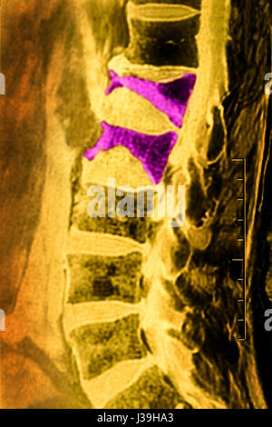 FRACTURE par tassement, IRM Banque D'Images