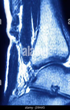 Rupture d'un tendon, IRM Banque D'Images