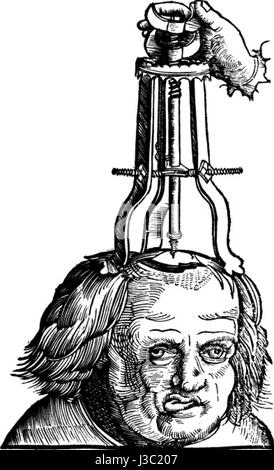 L'élévation d'une fracture du crâne déprimée est une procédure médicale visant à élever une partie du crâne qui a été déprimée en raison d'un traumatisme. Ceci est fait pour réduire la pression sur le cerveau et prévenir d'autres blessures. La procédure nécessite une attention médicale attentive et est généralement effectuée par un chirurgien qualifié. Banque D'Images