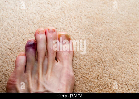 Broken toe montrant des contusions sur la peau à cause d'une blessure Banque D'Images