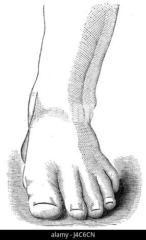 Cette image ou description fait probablement référence à une illustration détaillée d'un pied humain bien formé et en bonne santé, peut-être provenant du « Musée de l'école publique » ou d'une autre source éducative. Il met l'accent sur les caractéristiques anatomiques et l'importance d'une bonne santé des pieds. Banque D'Images