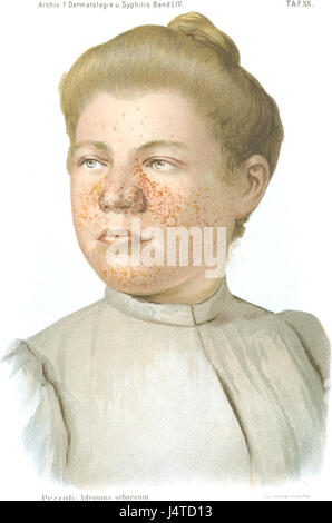 La sclérose tubéreuse est une maladie génétique qui provoque la formation de tumeurs non cancéreuses dans divers organes, y compris le cerveau. Pezzoli fait référence à une étude ou à un cas lié à cette condition, faisant progresser la recherche médicale sur ses effets et ses traitements. Banque D'Images