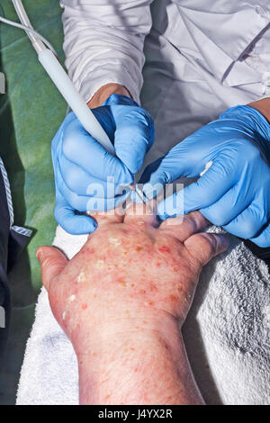 Dermatologue chirurgien élimine les maladies de peau avec electrocoagulator Banque D'Images