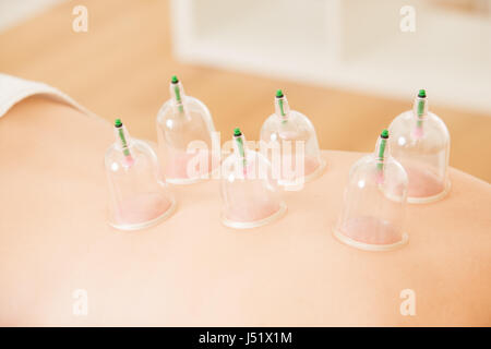 Close up image of woman with cupping poitrine sur le traitement clinique de médecine chinoise en arrière. l'intérieur de la médecine et de la santé concept. Banque D'Images