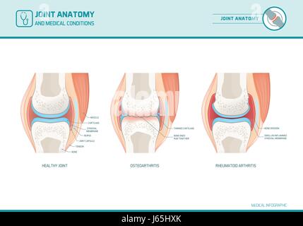 Anatomie des articulations, l'ostéoarthrite et l'arthrite rhumatoïde infographie avec illustrations anatomiques Illustration de Vecteur