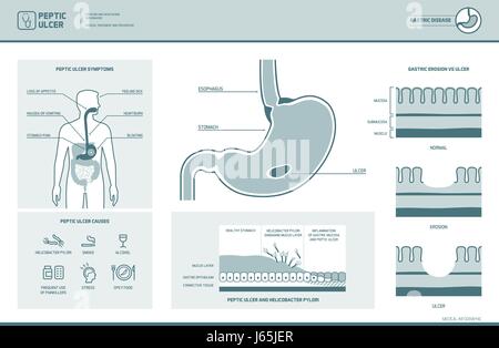 L'ulcère gastrique et helicobacter pylori infographie avec des symptômes et causes de l'estomac, diagramme de la coupe transversale, illustration médicale Illustration de Vecteur