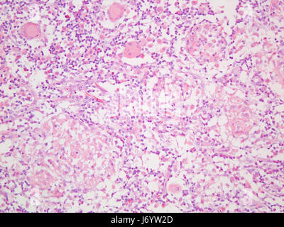 La maladie de Crohns Granulome dans l'intestin grêle Vue à 200x de grossissement avec coloration à l'éosine et Haemotoxylin. Banque D'Images