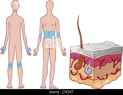Illustration de la peau maladie schéma cartoon comics maladie maladie psoriasis Banque D'Images