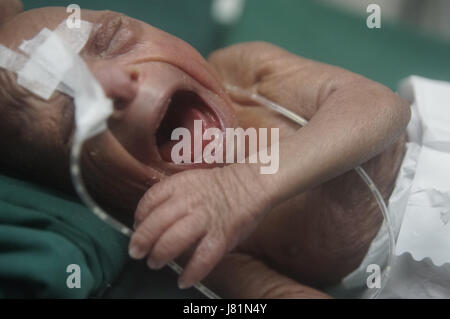 Dhaka, Bangladesh. 27 mai, 2017. Un bébé est né au Bangladesh Medical College Hospital il y a 4 jours avec une maladie génétique très rare appelée Progeria. Cet enfant progresse depuis sa naissance. Les médecins disent ; son poids de naissance était seulement.86 kg. Les enfants souffrant de cette maladie, apparaissent comme un très vieil homme. Leur processus de vieillissement est 8 fois plus rapide qu'un enfant normal.Hutchinson Gilbert Progeria Syndrome est appelé ce problème. En quelques millions, 1 enfant est né. Le prédécesseur est appelé vieillissement rapide. Fondamentalement, en raison d'un problème génétique, cet environnement est vu. Il n'y a pas de cause spécifique trouvé o Banque D'Images