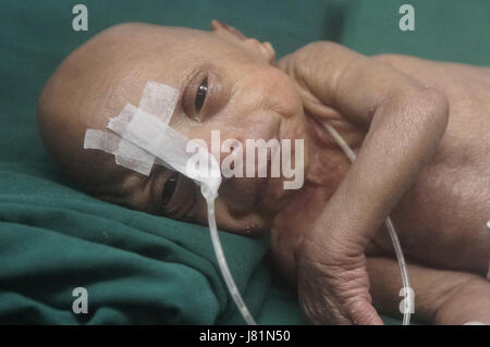 Dhaka, Bangladesh. 27 mai, 2017. Un bébé est né au Bangladesh Medical College Hospital il y a 4 jours avec une maladie génétique très rare appelée Progeria. Cet enfant progresse depuis sa naissance. Les médecins disent ; son poids de naissance était seulement.86 kg. Les enfants souffrant de cette maladie, apparaissent comme un très vieil homme. Leur processus de vieillissement est 8 fois plus rapide qu'un enfant normal.Hutchinson Gilbert Progeria Syndrome est appelé ce problème. En quelques millions, 1 enfant est né. Le prédécesseur est appelé vieillissement rapide. Fondamentalement, en raison d'un problème génétique, cet environnement est vu. Il n'y a pas de cause spécifique trouvé o Banque D'Images