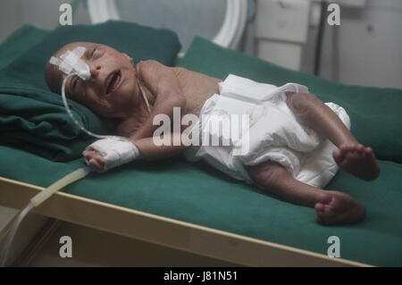 Dhaka, Bangladesh. 27 mai, 2017. Un bébé est né au Bangladesh Medical College Hospital il y a 4 jours avec une maladie génétique très rare appelée Progeria. Cet enfant progresse depuis sa naissance. Les médecins disent ; son poids de naissance était seulement.86 kg. Les enfants souffrant de cette maladie, apparaissent comme un très vieil homme. Leur processus de vieillissement est 8 fois plus rapide qu'un enfant normal.Hutchinson Gilbert Progeria Syndrome est appelé ce problème. En quelques millions, 1 enfant est né. Le prédécesseur est appelé vieillissement rapide. Fondamentalement, en raison d'un problème génétique, cet environnement est vu. Il n'y a pas de cause spécifique trouvé o Banque D'Images