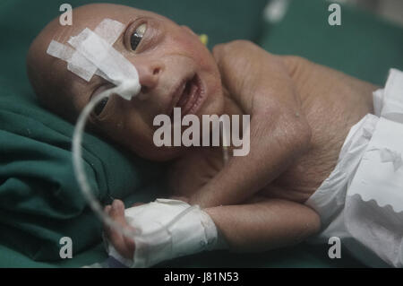 Dhaka, Bangladesh. 27 mai, 2017. Un bébé est né au Bangladesh Medical College Hospital il y a 4 jours avec une maladie génétique très rare appelée Progeria. Cet enfant progresse depuis sa naissance. Les médecins disent ; son poids de naissance était seulement.86 kg. Les enfants souffrant de cette maladie, apparaissent comme un très vieil homme. Leur processus de vieillissement est 8 fois plus rapide qu'un enfant normal.Hutchinson Gilbert Progeria Syndrome est appelé ce problème. En quelques millions, 1 enfant est né. Le prédécesseur est appelé vieillissement rapide. Fondamentalement, en raison d'un problème génétique, cet environnement est vu. Il n'y a pas de cause spécifique trouvé o Banque D'Images