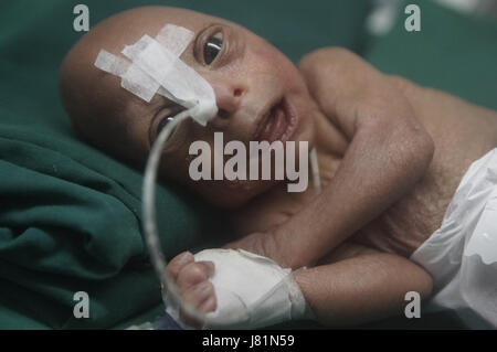 Dhaka, Bangladesh. 27 mai, 2017. Un bébé est né au Bangladesh Medical College Hospital il y a 4 jours avec une maladie génétique très rare appelée Progeria. Cet enfant progresse depuis sa naissance. Les médecins disent ; son poids de naissance était seulement.86 kg. Les enfants souffrant de cette maladie, apparaissent comme un très vieil homme. Leur processus de vieillissement est 8 fois plus rapide qu'un enfant normal.Hutchinson Gilbert Progeria Syndrome est appelé ce problème. En quelques millions, 1 enfant est né. Le prédécesseur est appelé vieillissement rapide. Fondamentalement, en raison d'un problème génétique, cet environnement est vu. Il n'y a pas de cause spécifique trouvé o Banque D'Images