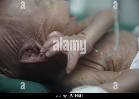 Dhaka, Bangladesh. 27 mai, 2017. Un bébé est né au Bangladesh Medical College Hospital il y a 4 jours avec une maladie génétique très rare appelée Progeria. Cet enfant progresse depuis sa naissance. Les médecins disent ; son poids de naissance était seulement.86 kg. Les enfants souffrant de cette maladie, apparaissent comme un très vieil homme. Leur processus de vieillissement est 8 fois plus rapide qu'un enfant normal.Hutchinson Gilbert Progeria Syndrome est appelé ce problème. En quelques millions, 1 enfant est né. Le prédécesseur est appelé vieillissement rapide. Fondamentalement, en raison d'un problème génétique, cet environnement est vu. Il n'y a pas de cause spécifique trouvé o Banque D'Images