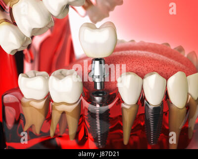 Implant dans le modèle de dents, gencives et denturas. Médecine dentaire stomatologie concept. 3d illustration Banque D'Images