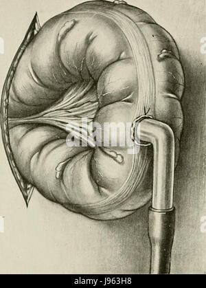 'Surgery, ses principes et pratique" (1906) Banque D'Images