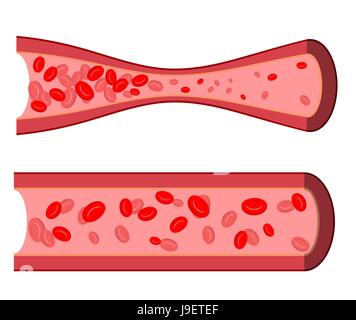 Artère sanglante. Blocage des vaisseaux sanguins. Artère malade avec les leucocytes. Les cellules de sang dans les droits de l'esprit de près. En bonne santé et les douloureux artère. Illustration de Vecteur