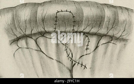 'Surgery, ses principes et pratique" (1906) Banque D'Images