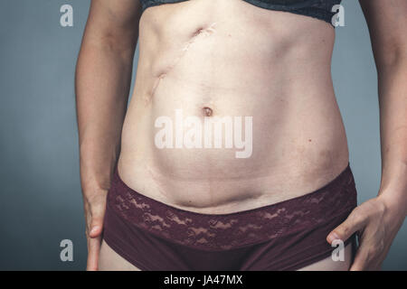 Femme ayant de multiples cicatrices sur l'abdomen long Banque D'Images