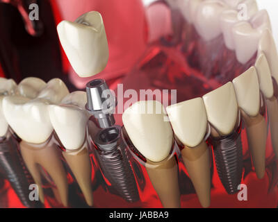 Implant dans le modèle de dents, gencives et denturas. Médecine dentaire stomatologie concept. 3d illustration Banque D'Images