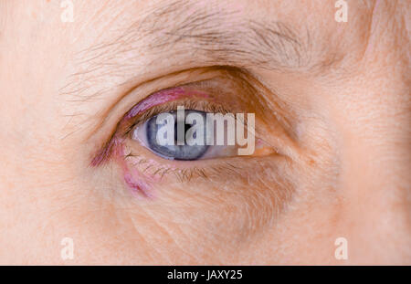 Woman's eye blessés pour cause de rupture de capillaire, provoquant un hématome ou une ecchymose. Il pourrait également être une conjonctivite allergique ou d'autres l'inflammation d'oeil Banque D'Images