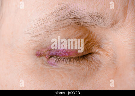 Woman's eye blessés pour cause de rupture de capillaire, provoquant un hématome ou une ecchymose. Il pourrait également être une conjonctivite allergique ou d'autres l'inflammation d'oeil Banque D'Images