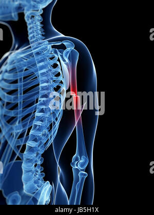 Illustration médicale d'un os du bras de borken Banque D'Images