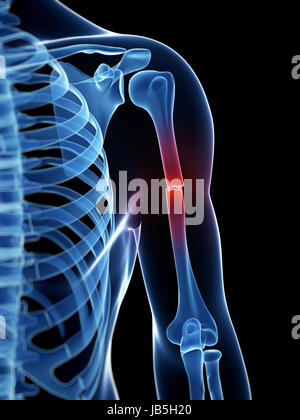 Illustration médicale d'un os du bras de borken Banque D'Images