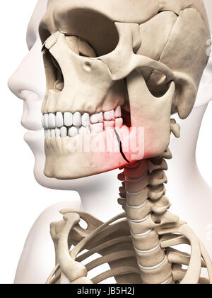 Illustration médicale d'une fracture de l'os de la mâchoire Banque D'Images