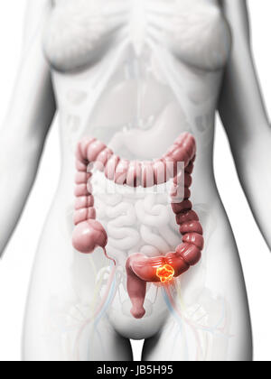 Rendu 3d illustration de cancer du colon Banque D'Images