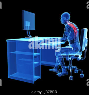 Rendu 3d illustration médicale - mauvaise position d'assise Banque D'Images