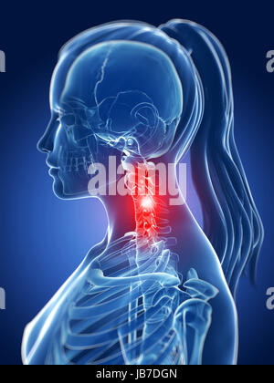 Rendu 3d - illustration médicale cou douloureux Banque D'Images