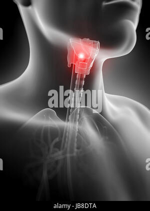 Rendu 3d illustration de l'inflammation de la glande thyroïde Banque D'Images