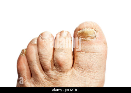 L'infection à champignon sur les ongles de pied de l'homme Banque D'Images