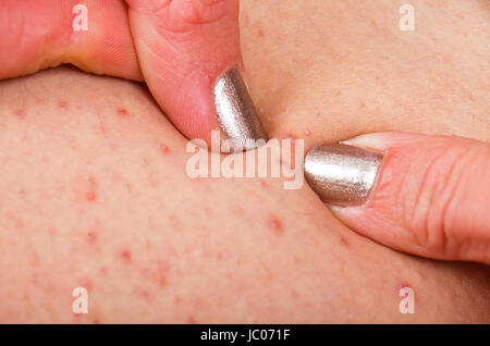 Close up photo de folliculite sur la peau humaine, l'éclater les doigts femme Banque D'Images