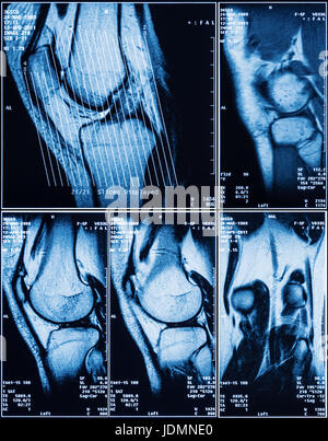 Les droits de l'IRM du genou pour le diagnostic médical Banque D'Images